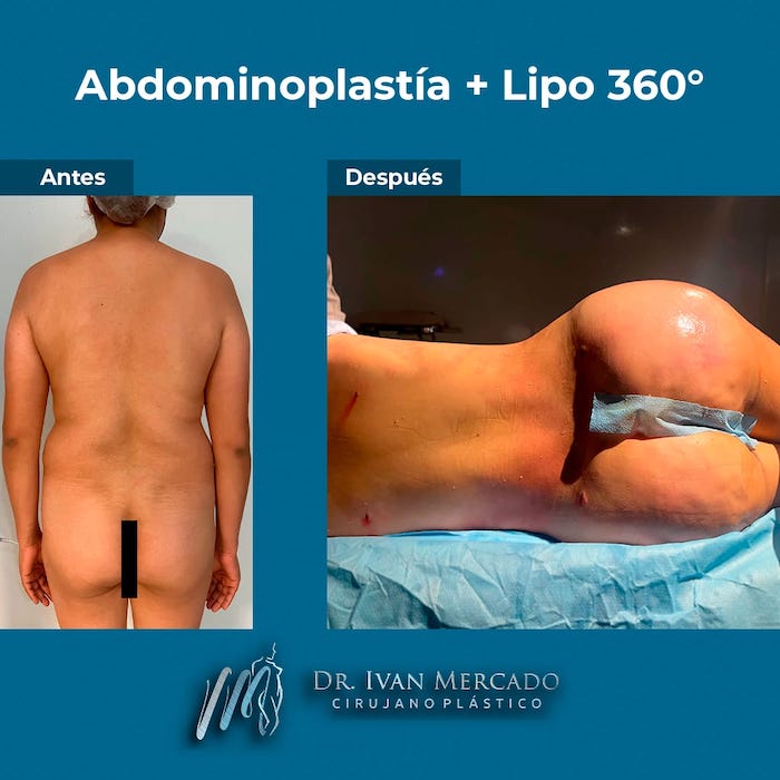 Recuperación de la abdominoplastia día por día ▻ Cirujano Plástico Dr.  Guevara